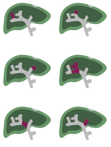 Classification of macroscopic PVI Vp1-3 graphic